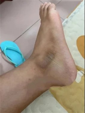 التقشير الأصفر (Yellow Peeling) – Image 4