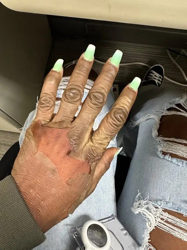 التقشير الأصفر (Yellow Peeling) – Image 6